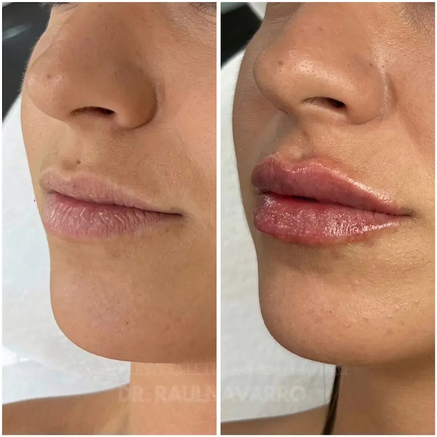 medicina estética - remodelado de labios (4)